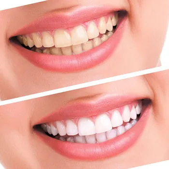 Karšto Dantų Balinimo Gelio Rinkinys Dantų Balinimo Sistema, Žodžiu Gelio Rinkinys Profesionali Odontologijos Įranga Šaltos Šviesos Dantų Grožį