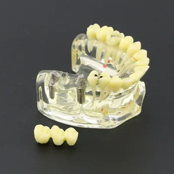 Dantų Studijų Mokyti Dantų Modelio Dantų Implantą Viršutiniame Žandikaulyje Modelis Su Tiltas & Ėduonies