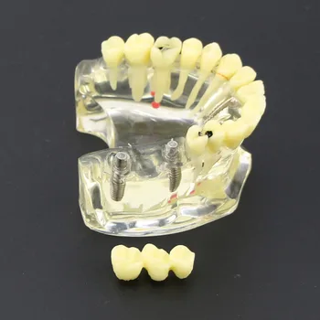Dantų Studijų Mokyti Dantų Modelio Dantų Implantą Viršutiniame Žandikaulyje Modelis Su Tiltas & Ėduonies