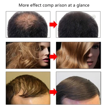 Imbieras Plaukų Augimo Esmė Maitina Stabdžių Užkirsti Kelią Plaukų Slinkimas Produktų Priežiūros, Plaukų Esminius Moterų Ir Vyrų Plaukų Remonto Auga Greičiau